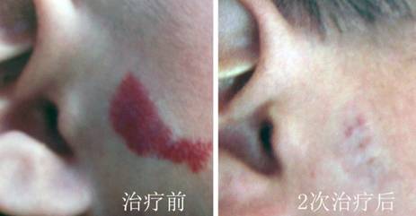1586927520929.jpg 综合方案治疗婴幼儿血管瘤 图片.jpg