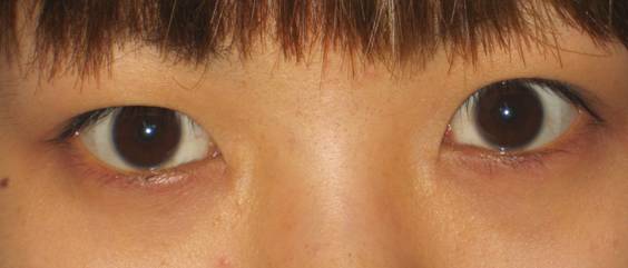 1587612674368.jpg 陈文 内眼角开大的新方法 图片1.jpg