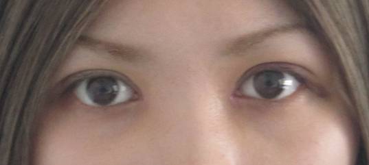 1587612695456.jpg 陈文 内眼角开大的新方法 图片2.jpg