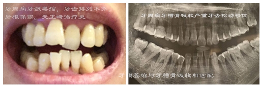 1585292202665.jpg 吕长胜 整牙的并发症和预防(附照)6.jpg