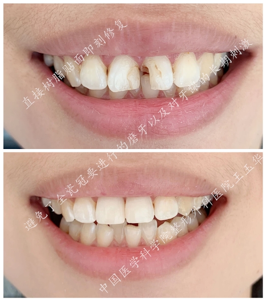 1585292245436.jpg 吕长胜 整牙的并发症和预防(附照)9.jpg