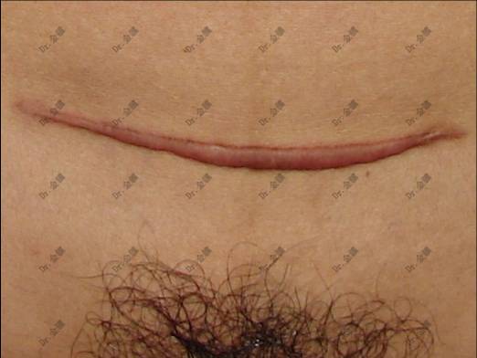 1586927248570.jpg 金骥 剖腹产瘢痕 图片2.jpg